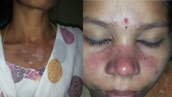 Malar Rash Back SLE malar rash - Medi Edu Tv